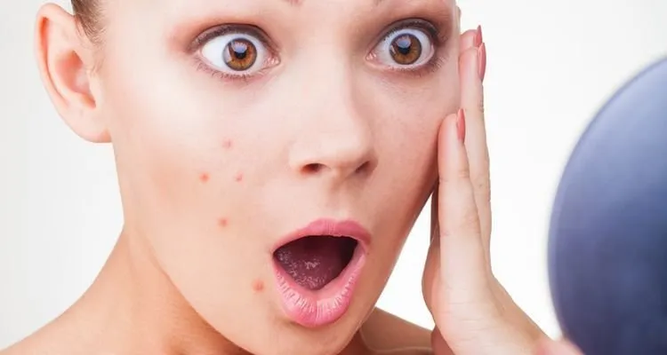 6+ Tips Ampuh Hilangkan Jerawat Level Frustasi dengan Cepat. Simak dan Terapkan dengan Cermat Ya! 13