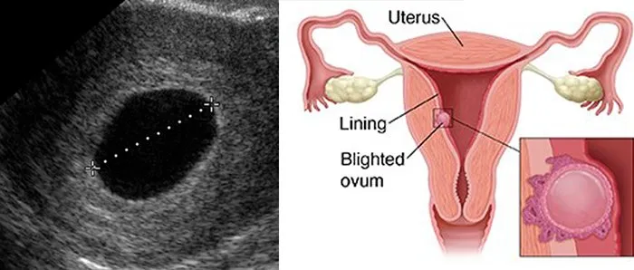 6 Fakta Hamil Kosong atau Blighted Ovum. Gejalanya Hamil, tapi Janin Tak Berkembang Sempurna 7