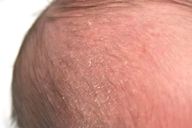 5 Rahasia Menjadikan Rambut Si Kecil Menjadi Hitam, Lebat dan Sehat. Murah, Asal Telaten! 6