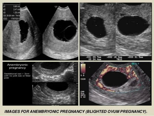 6 Fakta Hamil Kosong atau Blighted Ovum. Gejalanya Hamil, tapi Janin Tak Berkembang Sempurna 10