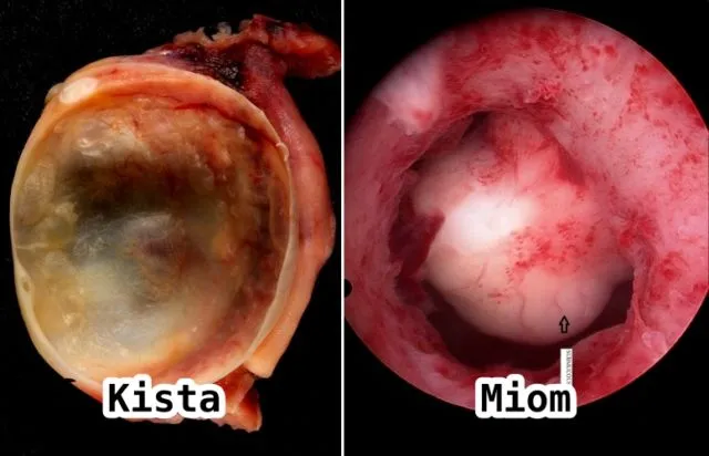 Perbedaan Kista dan Mioma, Gangguan Umum pada Organ Reproduksi Wanita 7 perbedaan kista dan miom