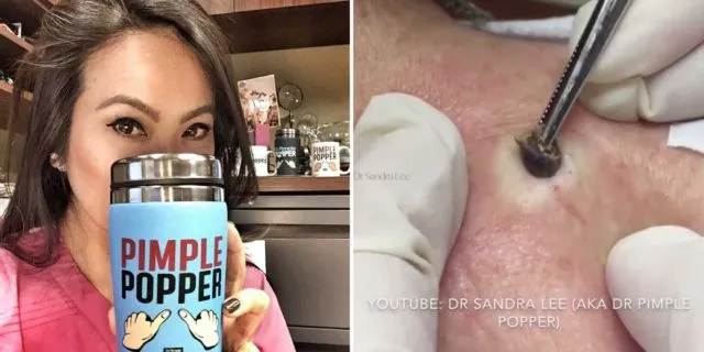 Menjijikan Tapi Buat Ketagihan. Ini Alasan Banyak Banget Orang Betah Nonton Video Pencet Komedo 6