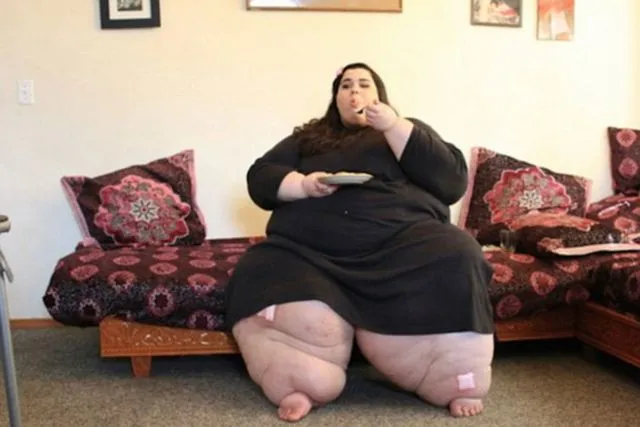 Bobot 299 Kilo Amber Rachdi Susut Drastis Berkat Operasi Gastric Bypass. Kayak Apa Sih Prosedurnya? 9