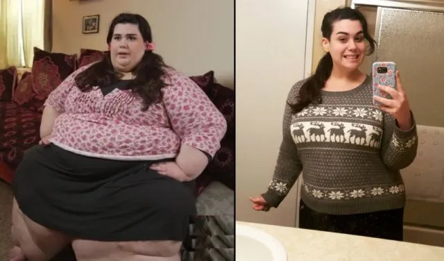Bobot 299 Kilo Amber Rachdi Susut Drastis Berkat Operasi Gastric Bypass. Kayak Apa Sih Prosedurnya? 16