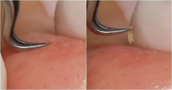 Menjijikan Tapi Buat Ketagihan. Ini Alasan Banyak Banget Orang Betah Nonton Video Pencet Komedo 7