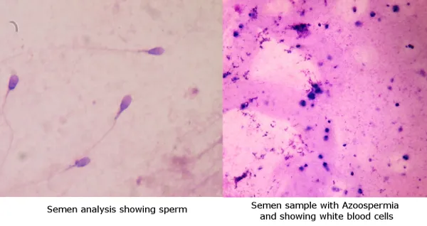 Azoospermia, Kelainan Pada Sperma Cowok yang Bikin Sulit Menghamili. Waspada Meski Nggak Mengalami 6