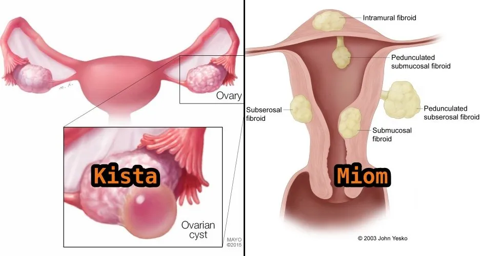 Perbedaan Kista dan Mioma, Gangguan Umum pada Organ Reproduksi Wanita