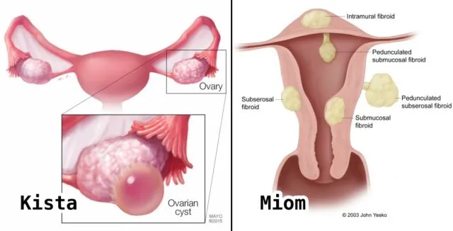 Perbedaan Kista dan Mioma, Gangguan Umum pada Organ Reproduksi Wanita 9 perbedaan kista dan miom