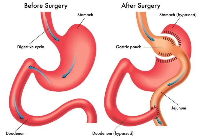 Bobot 299 Kilo Amber Rachdi Susut Drastis Berkat Operasi Gastric Bypass. Kayak Apa Sih Prosedurnya? 10