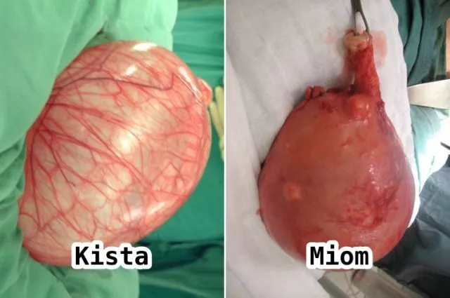 Perbedaan Kista dan Mioma, Gangguan Umum pada Organ Reproduksi Wanita 8 perbedaan kista dan miom