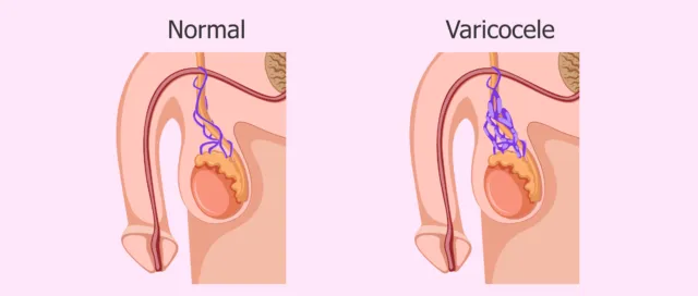 Azoospermia, Kelainan Pada Sperma Cowok yang Bikin Sulit Menghamili. Waspada Meski Nggak Mengalami 9