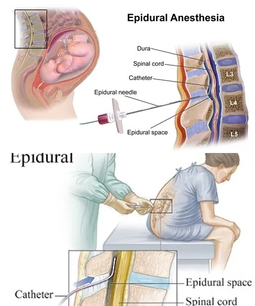 7 Fakta Penting Tentang Epidural, Bius Penahan Rasa Sakit untuk Ibu Melahirkan! 11