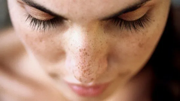 Hampir Mirip, ini lo Bedanya Freckles, Flek Hitam, dan Melasma 10 bedanya freckles dan flek hitam