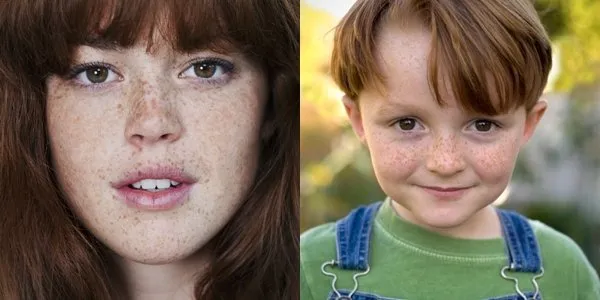 Hampir Mirip, ini lo Bedanya Freckles, Flek Hitam, dan Melasma 7 bedanya freckles dan flek hitam