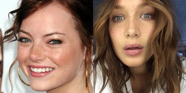 Hampir Mirip, ini lo Bedanya Freckles, Flek Hitam, dan Melasma 9 bedanya freckles dan flek hitam
