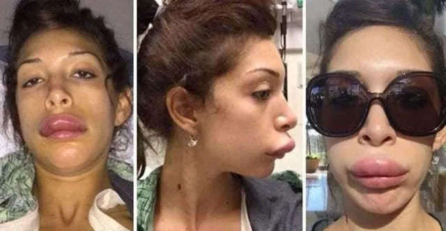 Banyak Jadi Tren, Ternyata Ini 5 Fakta Penting Soal Filler Bibir. Pahami Dulu Sebelum Ikut-ikutan 8