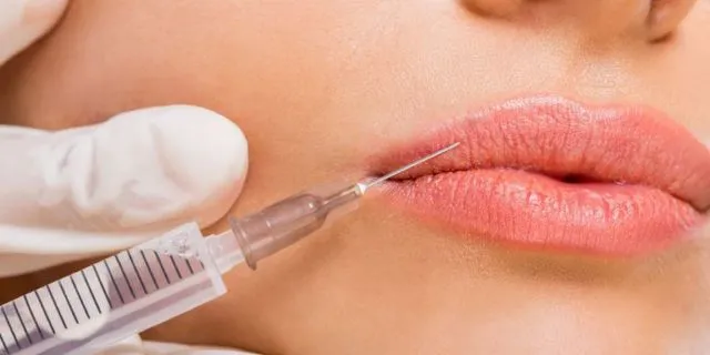 Banyak Jadi Tren, Ternyata Ini 5 Fakta Penting Soal Filler Bibir. Pahami Dulu Sebelum Ikut-ikutan 6