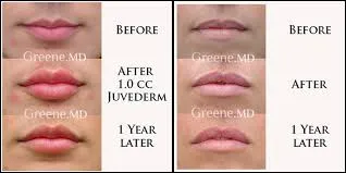 Banyak Jadi Tren, Ternyata Ini 5 Fakta Penting Soal Filler Bibir. Pahami Dulu Sebelum Ikut-ikutan 9
