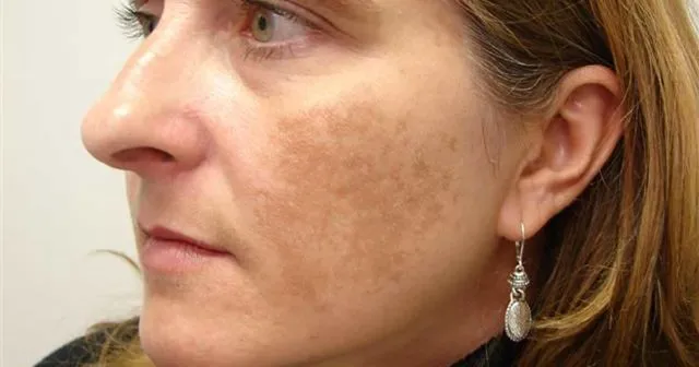 Hampir Mirip, ini lo Bedanya Freckles, Flek Hitam, dan Melasma 11 bedanya freckles dan flek hitam