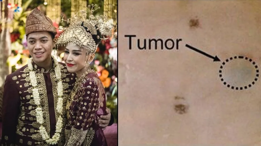 Deteksi Dini Kanker Kulit dengan ‘Sakuri’, Penyakit yang Renggut Nyawa Menantu Hatta Rajasa