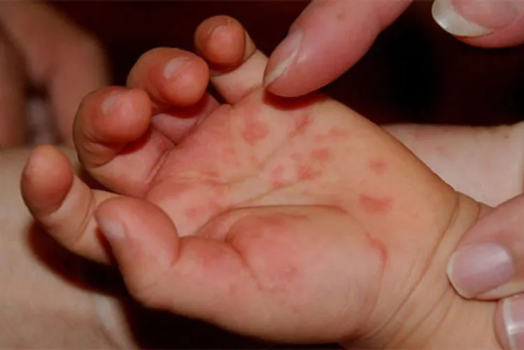 6 Fakta Seputar Flu Singapura yang Kerap Menyerang Bayi dan Balita. Para Ibu Muda Wajib Waspada 9