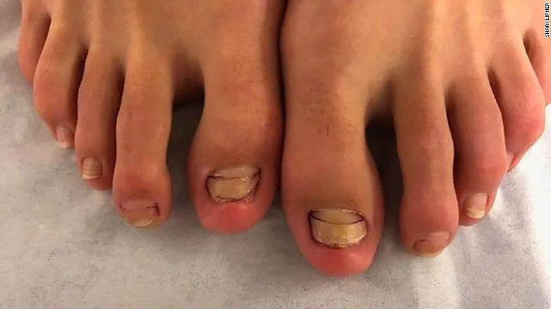 Mencoba Spa Ikan Beberapa Bulan Lalu, Kuku Kaki Gadis Ini Copot Karena Infeksi. Mesti Hati-Hati Gaes 5
