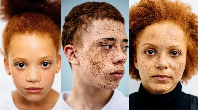 Ini Penyebab Terbentuknya Freckles di Kulit. Beda Sama Tren Make-up, Ada yang Punya Secara Alami 17