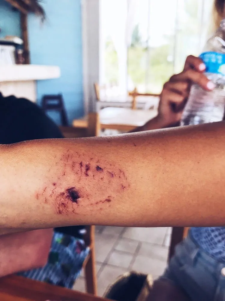 Selebgram Ini Digigit Hiu Saat Berpose di Pantai. Pengorbanan Demi Instagram Memang Berat, Gaes! 5