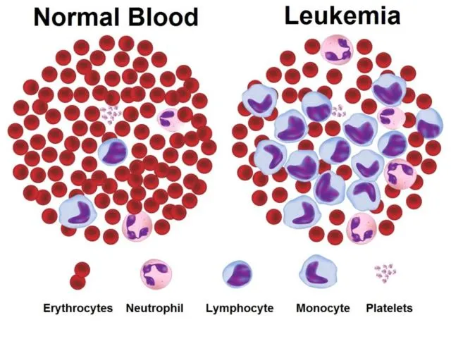 Belajar dari Buah Hati Denada, 5 Upaya Pencegahan Leukimia Ini Nggak Ada Salahnya Dicoba 9