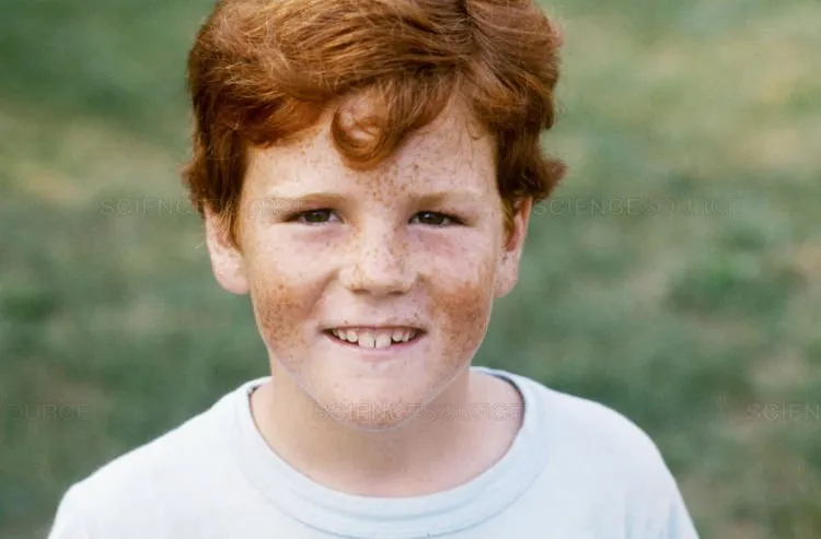 Ini Penyebab Terbentuknya Freckles di Kulit. Beda Sama Tren Make-up, Ada yang Punya Secara Alami 18