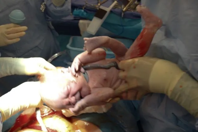 Gambaran Tali Pusar Bayi Baru Lahir yang Memikat, Usai Dipotong Pun Perlu Dirawat 27