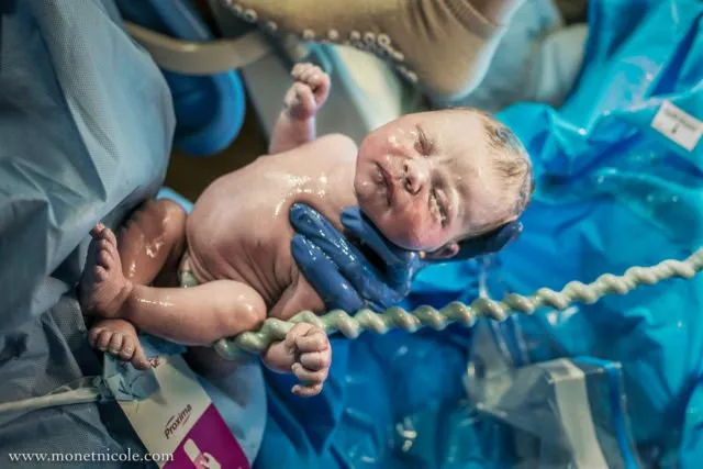 Gambaran Tali Pusar Bayi Baru Lahir yang Memikat, Usai Dipotong Pun Perlu Dirawat 19