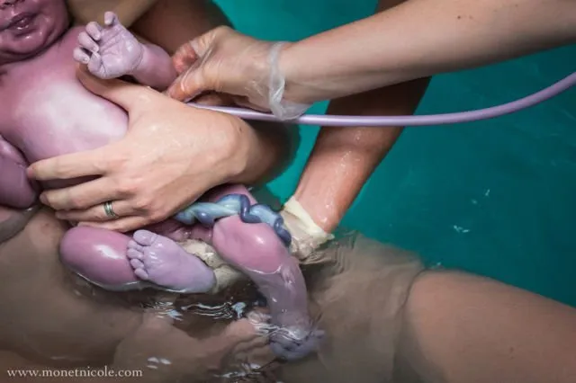 Gambaran Tali Pusar Bayi Baru Lahir yang Memikat, Usai Dipotong Pun Perlu Dirawat 25