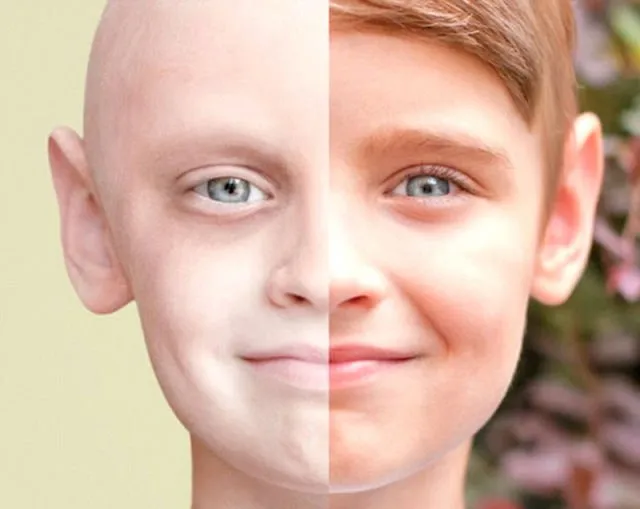 Belajar dari Buah Hati Denada, 5 Upaya Pencegahan Leukimia Ini Nggak Ada Salahnya Dicoba 11