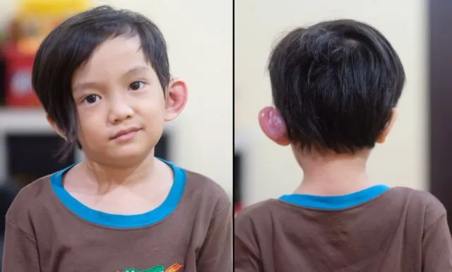 Tentang Infeksi Sinus Preauricular yang Diderita Anak Anji, dan Hubungannya dengan Lubang Telinga Mini 6