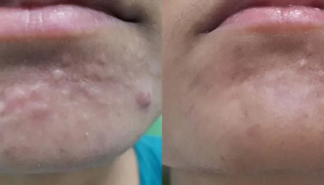 7 Kondisi Kulit Ini Sering Kita Anggap Jerawat. Padahal Bukan Lho, Cuma Mirip Saja 12