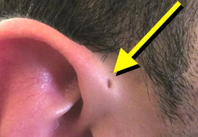 Tentang Infeksi Sinus Preauricular yang Diderita Anak Anji, dan Hubungannya dengan Lubang Telinga Mini 5