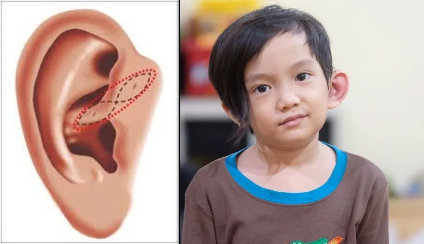 Tentang Infeksi Sinus Preauricular yang Diderita Anak Anji, dan Hubungannya dengan Lubang Telinga Mini