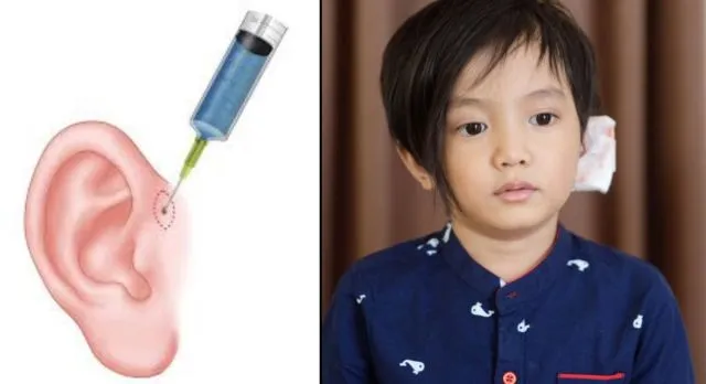 Tentang Infeksi Sinus Preauricular yang Diderita Anak Anji, dan Hubungannya dengan Lubang Telinga Mini 7
