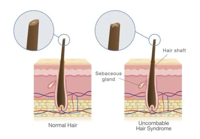 Ini Dia Sindrom Rambut Jabrik, Kondisi Langka yang Bikin Rambut Sulit Sekali Disisir 7