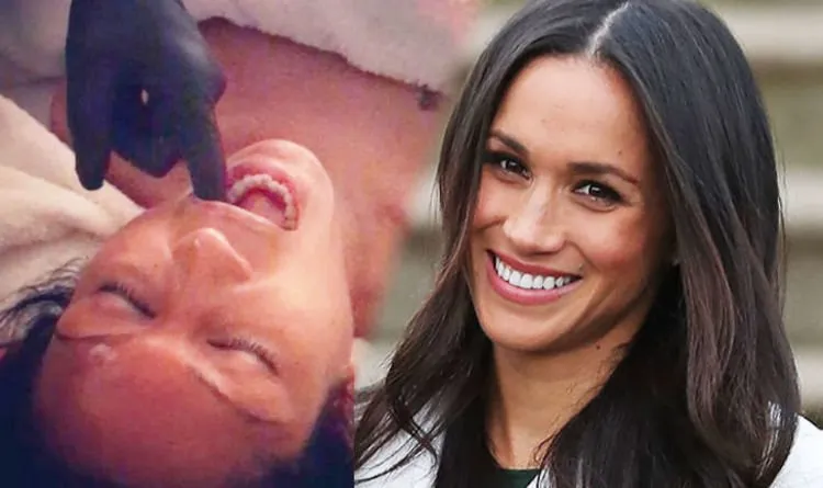 8 Fakta Seputar Facial Buccal, Perawatan 'Obok-obok Mulut' Favoritnya Meghan Markle. Katanya Sih Bikin Glowing Instant 10