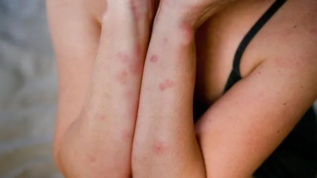 9 Fakta Seputar Tungau yang Mungkin Sedang Menghuni Kamarmu. Hiy, Geli~ 10 fakta tentang tungau