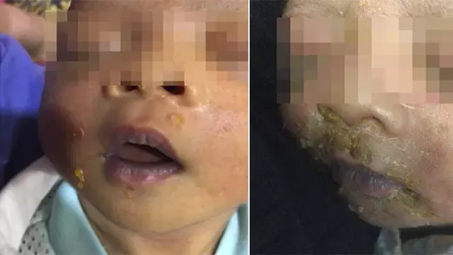 Stop Sembarangan Pegang & Cium Bayi Baru Lahir, Kalau Tidak Mau Kulitnya Jadi Melepuh Kayak Gini 5