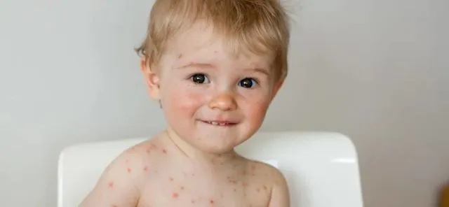 Penyakit Rubella Ancam Aceh Gara-Gara Plt Gubernur Tunda Vaksinasinya. Kesehatan Anak Jadi Taruhan 9