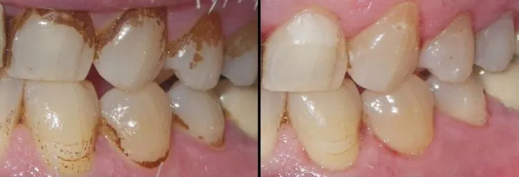 5 Alasan Kenapa Kamu Nggak Boleh Malas Scaling Karang Gigi. Bukan Cuma Bau Mulut, Penyakit Jantung Pun Bisa Mengintai 7
