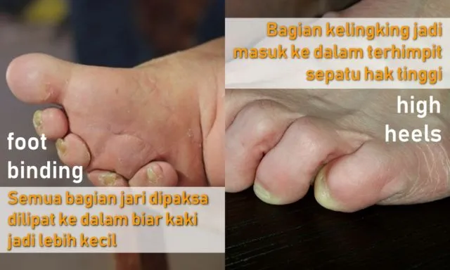 Antara Foot Binding dan High Heels, Perempuan Masih Saja Menyiksa Kakinya Demi Merasa Cantik 16