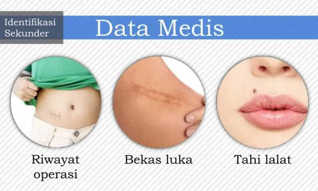 7 Cara Identifikasi Jenazah yang Bisa Diupayakan untuk Kenali Korban. Dari Gigi, DNA, Hingga Tato 11