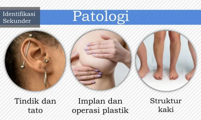 7 Cara Identifikasi Jenazah yang Bisa Diupayakan untuk Kenali Korban. Dari Gigi, DNA, Hingga Tato 12