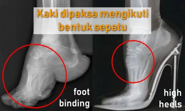 Antara Foot Binding dan High Heels, Perempuan Masih Saja Menyiksa Kakinya Demi Merasa Cantik 17