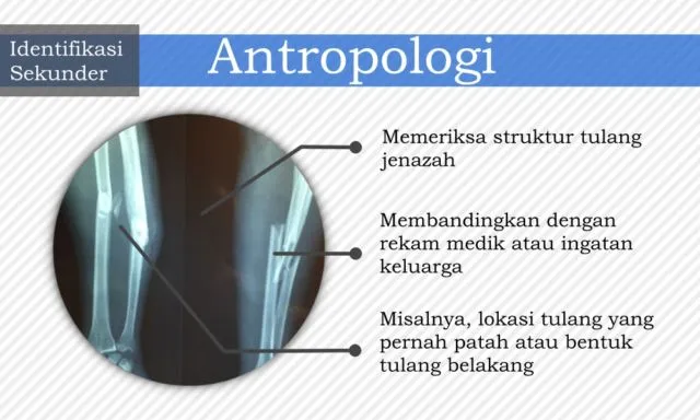 7 Cara Identifikasi Jenazah yang Bisa Diupayakan untuk Kenali Korban. Dari Gigi, DNA, Hingga Tato 13